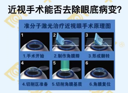 近視手術能否去除眼底病變？