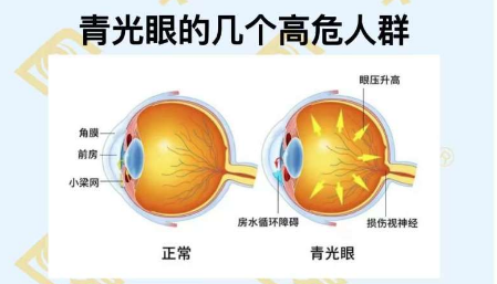 青光眼的幾個高危人群？