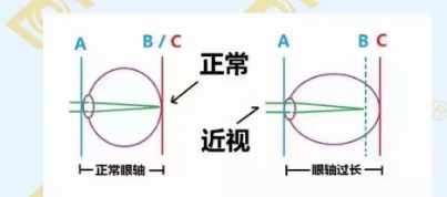 哪個年齡近視度數(shù)最容易增長？