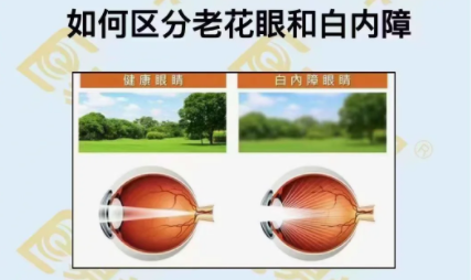 如何區(qū)分老花眼和白內(nèi)障？