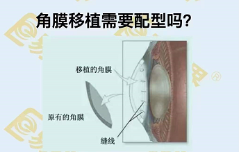 角膜移植需要配型嗎？