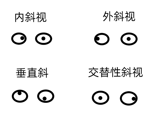 斜視早期的癥狀有哪些？